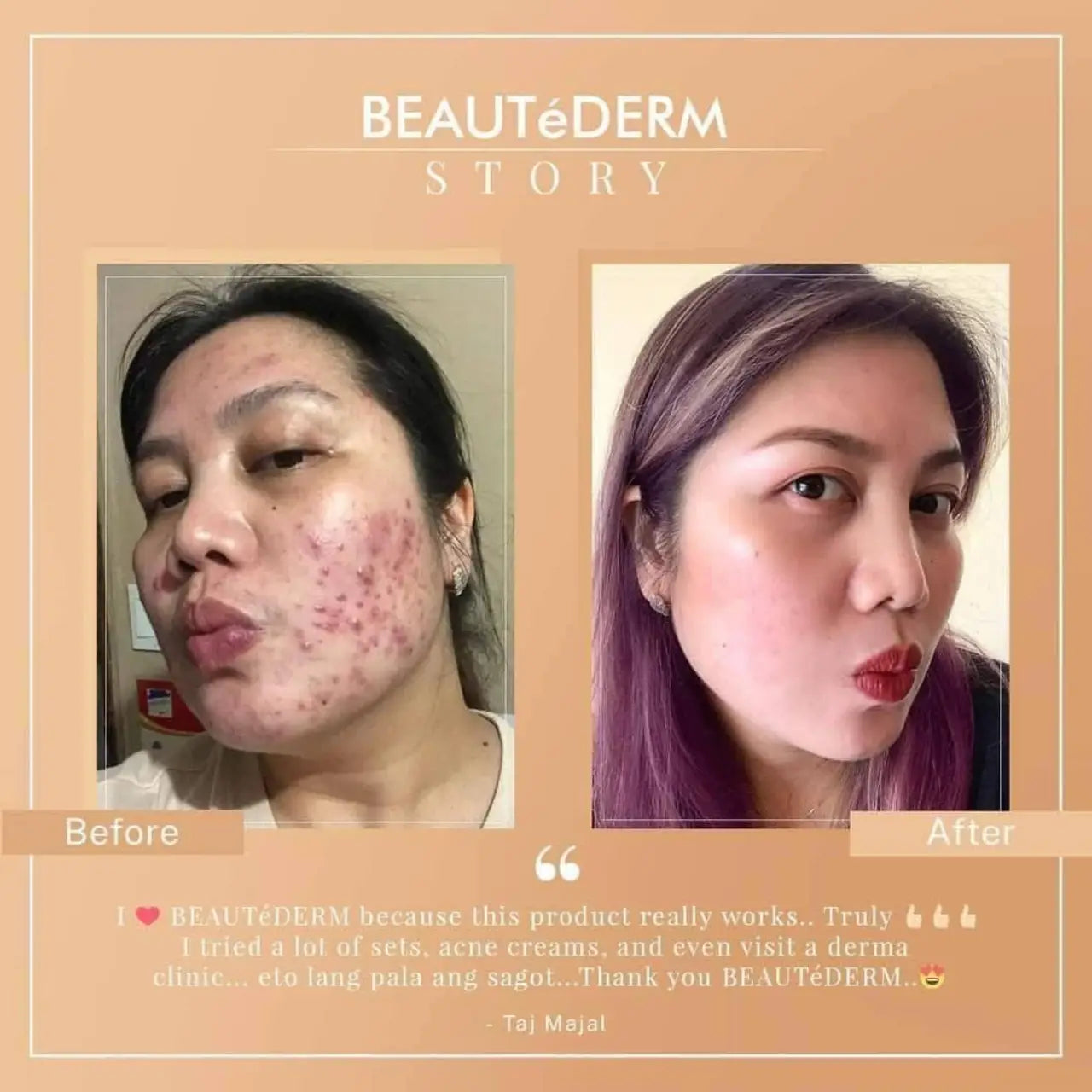 Trial Set plus FREEBIES (Good for 1 month) | Beautederm