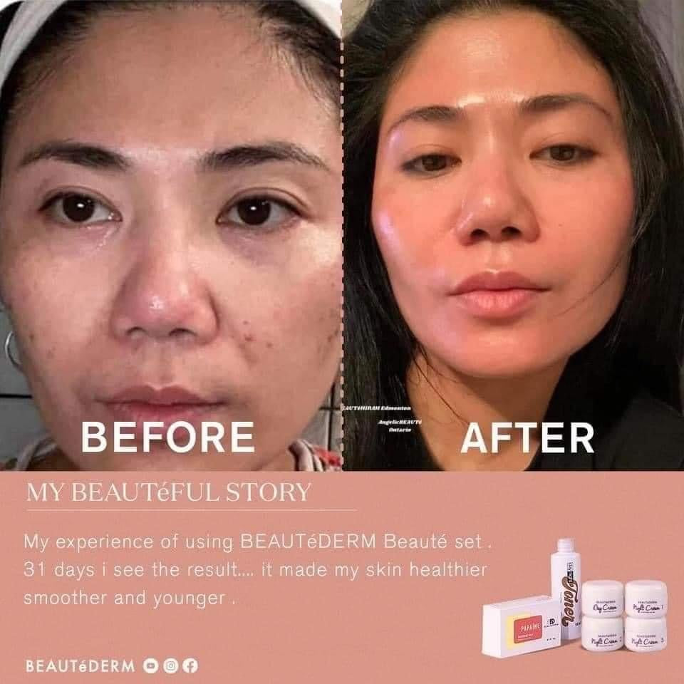 Trial Set plus FREEBIES (Good for 1 month) | Beautederm