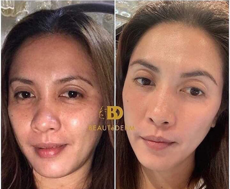 Beautederm skin transformation testimonial by happy customer