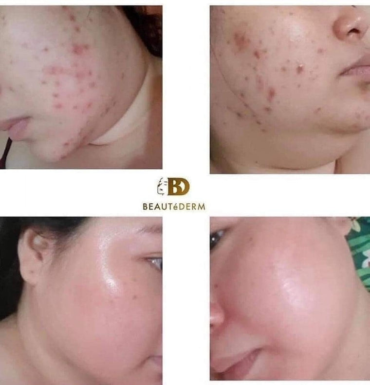 Testimonial shows image of customer with blemishes free , acne free , spotless radiant face with beautederm canada 