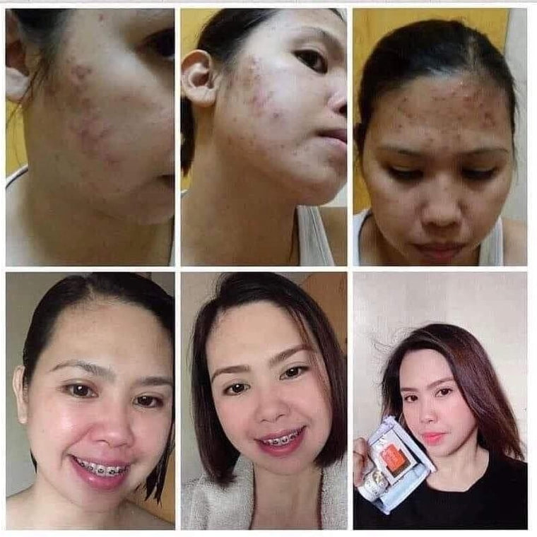 Image of happy and statisfied customer got clear , acne scars free , brighter face with beautederm canada