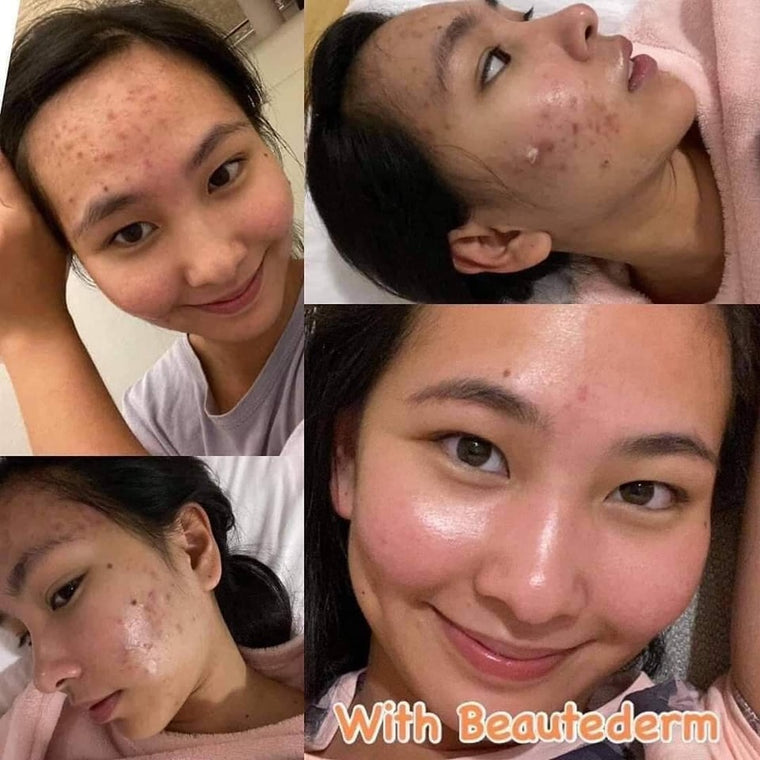 Beautederm happy customer with acnefree ,glowing and clear face after the use of products