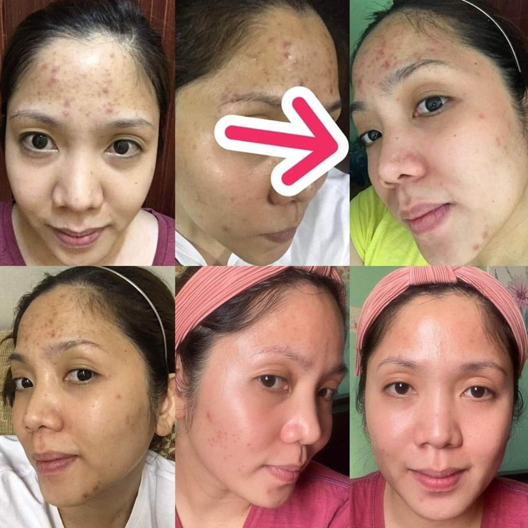 Beautederm testimonies- happy customer’s before and after pictures- beautederm Canada 