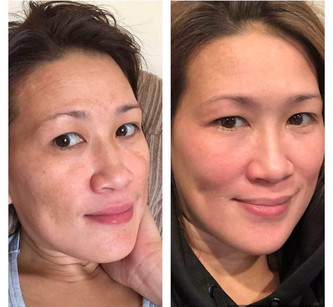 Beautederm testimonial before and after transformation - beautyderm