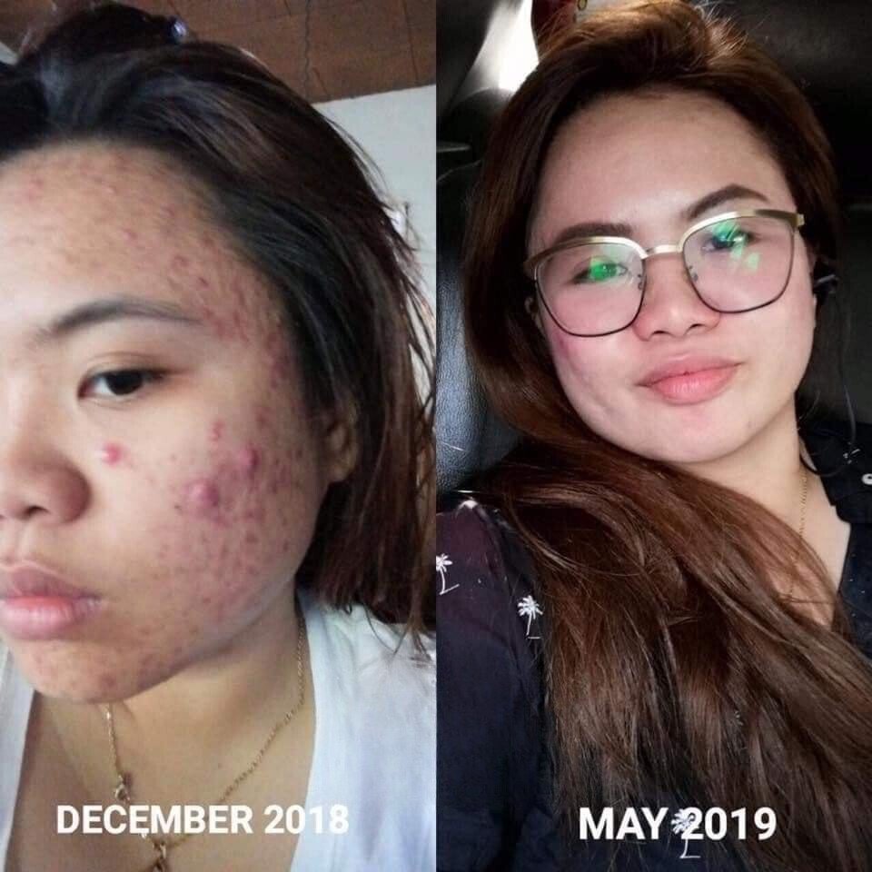 Beautederm testimonial - beautederm philippines